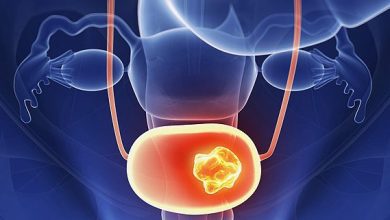 سرطان مثانه؛ بیشترین خطر جانی در بین مردان ایرانی