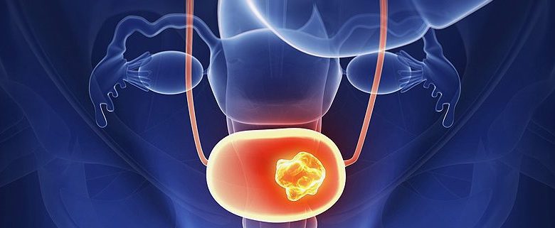 سرطان مثانه؛ بیشترین خطر جانی در بین مردان ایرانی